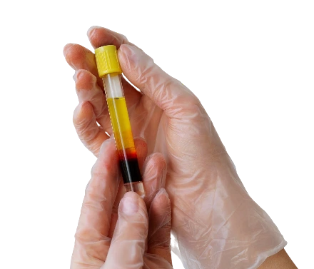 Hematuria
