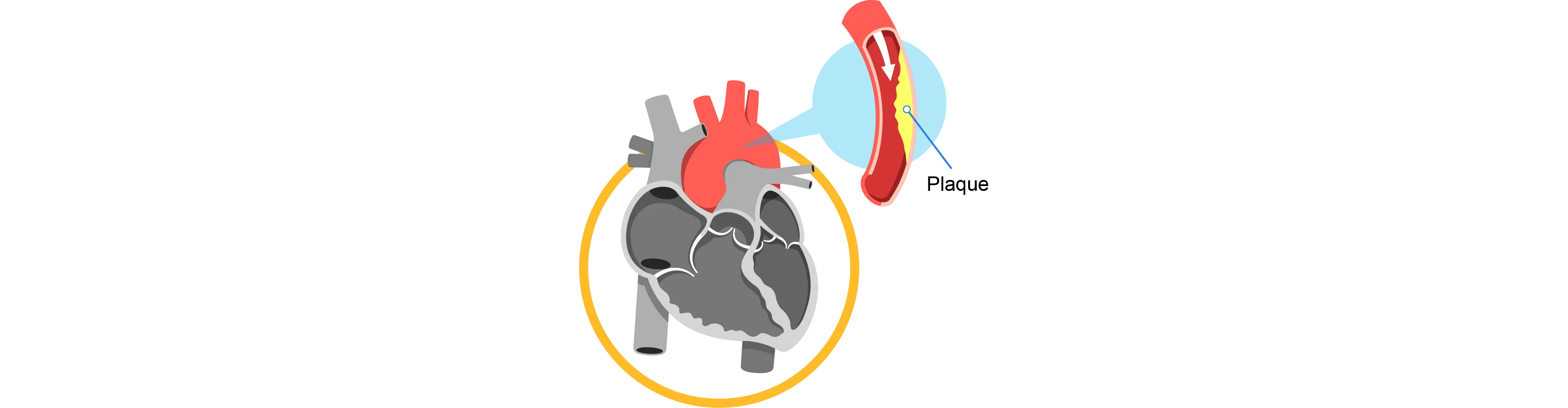 plaque build-up in coronary arteries